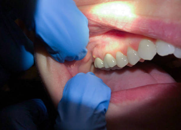 Best Teeth Whitening  in Eagle Lake, FL
